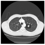 Terbongkar! Lung Cancer Dataset Download Csv Terpecaya