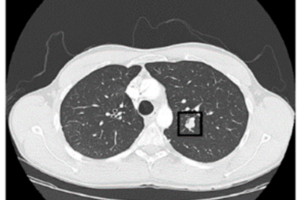 Terbongkar! Lung Cancer Dataset Download Csv Terpecaya