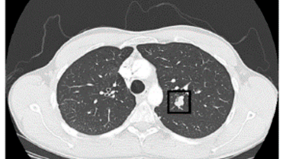 Terbongkar! Lung Cancer Dataset Download Csv Terpecaya