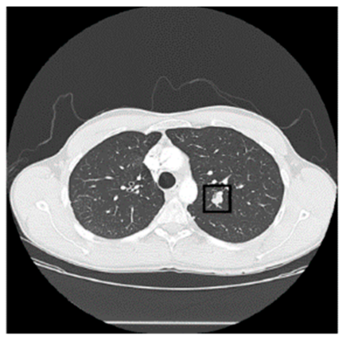 Luna16 Lung Cancer Dataset | Kaggle